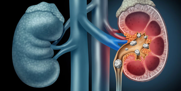 kidney_cancer_causes